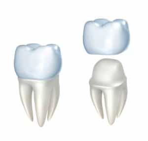 Read more about the article Is a dental crown right for you?