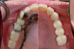 The Center for Excellence implant bridges